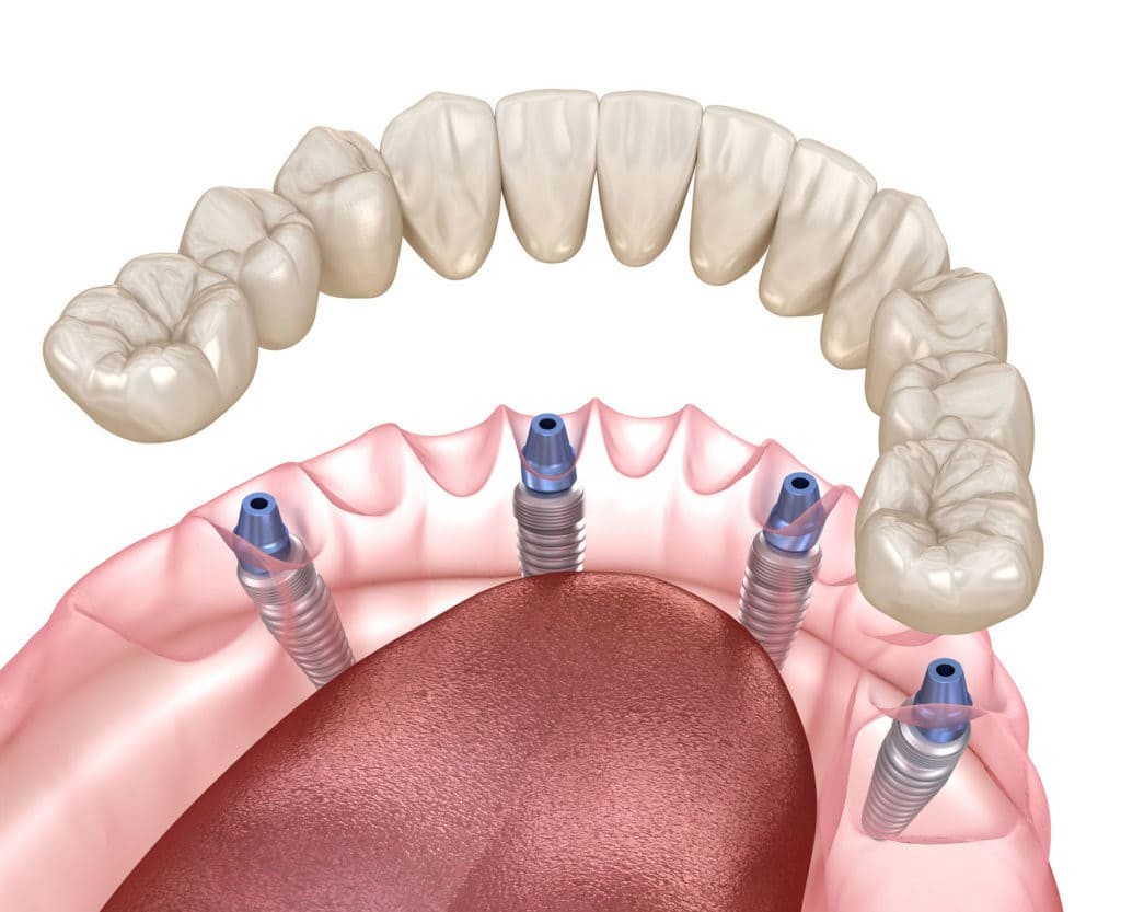 Clínica dental en Hospitalet del Llobregat especializada en carga inmediata, All-on-4 y rehabilitación oral avanzada Clínica dental en Hospitalet del Llobregat especializada en carga inmediata, All-on-4 y rehabilitación oral avanzada