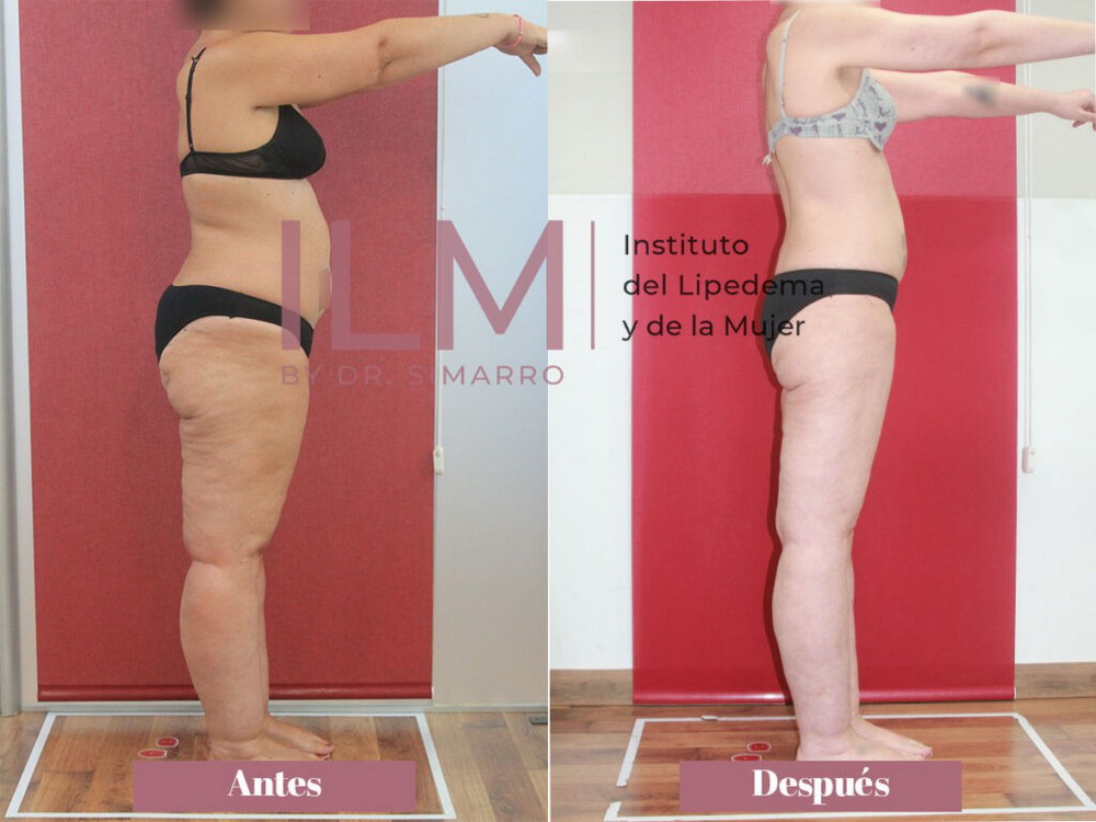 Lipedema y autoestima
