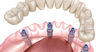 Clínica dental en Hospitalet del Llobregat especializada en carga inmediata, All-on-4 y rehabilitación oral avanzada Clínica dental en Hospitalet del Llobregat especializada en carga inmediata, All-on-4 y rehabilitación oral avanzada